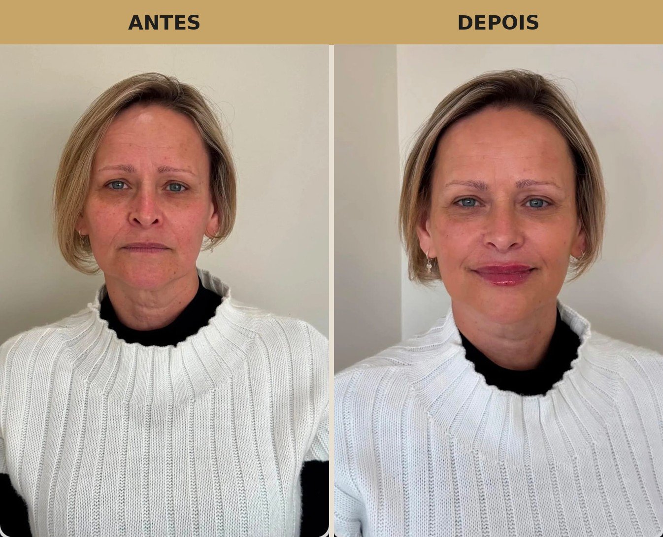Resultado de preenchimento labial: antes e depois