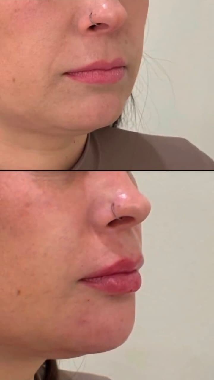 Resultado de preenchimento labial: antes e depois, em perfil