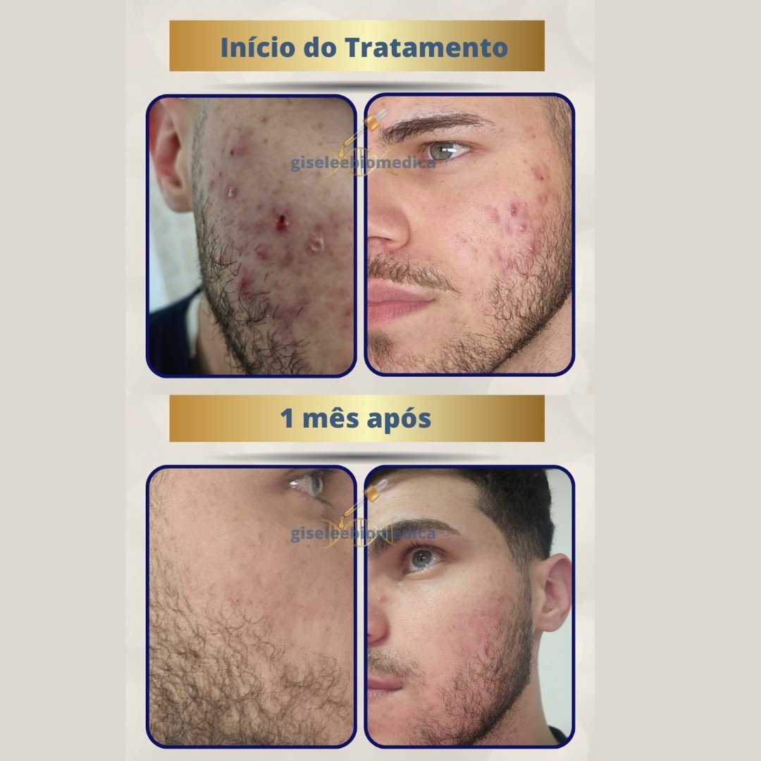 Resultado de tratamento para acne: início do tratamento e evolução após 1 mês